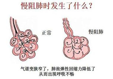 慢性阻塞性肺疾病的癥狀及預防緩解措施有哪些
