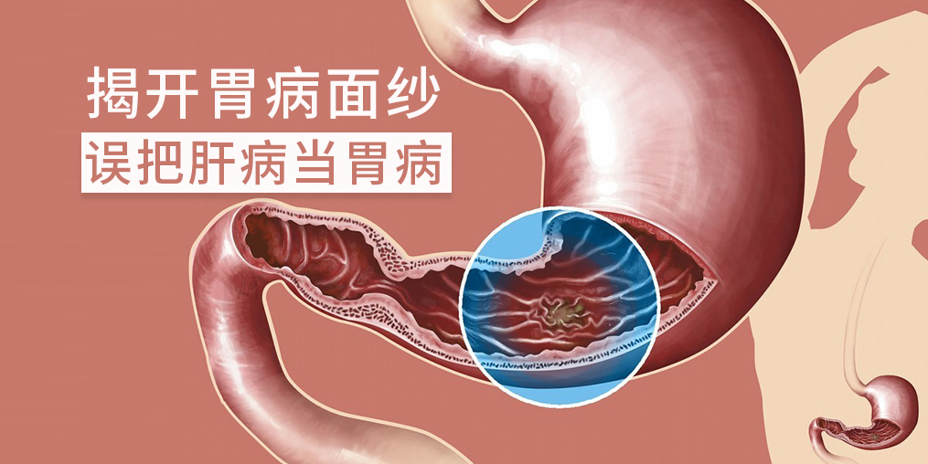 警惕“假胃病”，小心是肝有問題