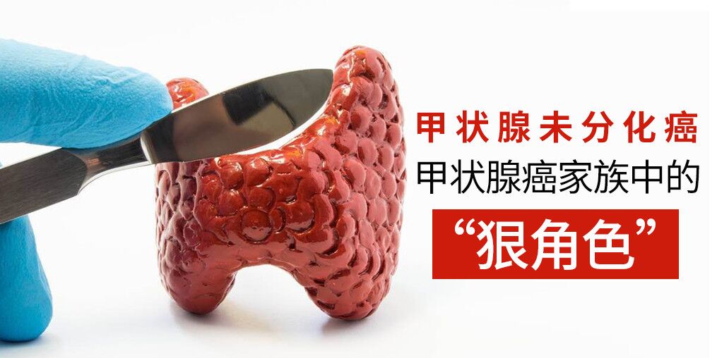 別忽視甲狀腺癌，它的家族也有“狠角色”